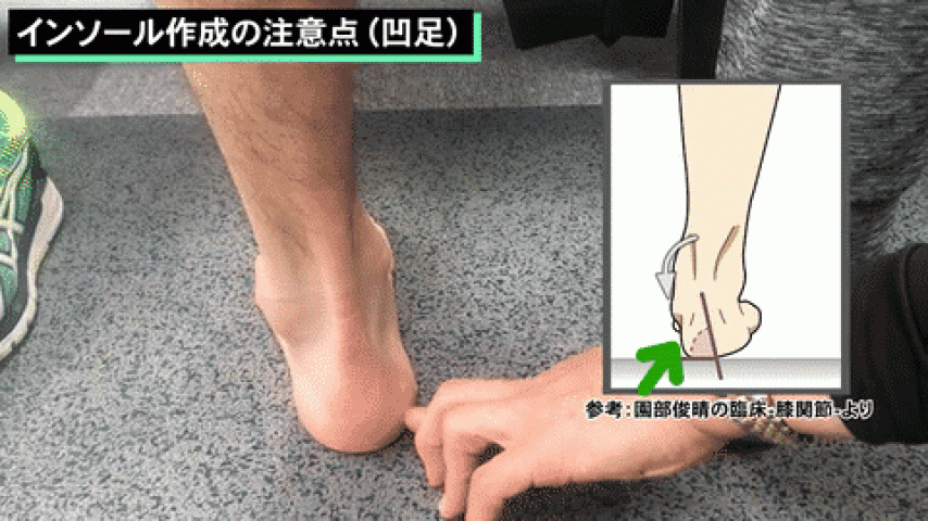 凹足に対するインソール作成で注意すること（園部俊晴の臨床）