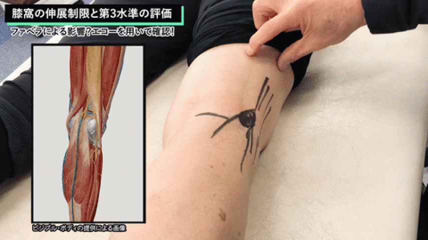 ファベラによる影響？膝窩の伸展制限と第3水準の評価（園部俊晴の臨床）